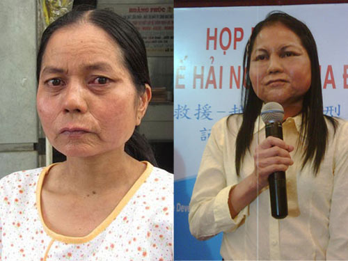 “Cô gái thành bà già” ở Quảng Nam đã trẻ lại nhiều