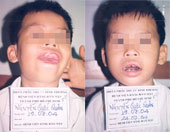 Bệnh viện Răng Hàm Mặt TPHCM: Điều trị 2 ca u sợi hàm hiếm gặp