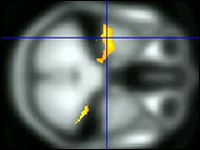 Chụp MRI tiên đoán tâm thần phân liệt