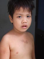 Tạm đình chỉ “bảo mẫu” đánh trẻ trọng thương