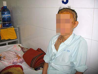 Điều trị túi phình động mạch não dưới kính hiển vi