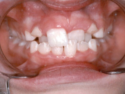 Lơ là răng sữa, phải "chữa" nụ cười