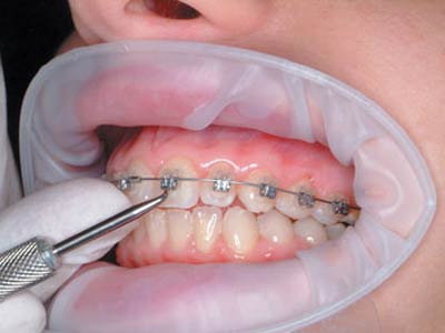 Tuổi nào chỉnh răng tốt nhất?