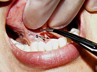 Dính thắng lưỡi là phải cắt?