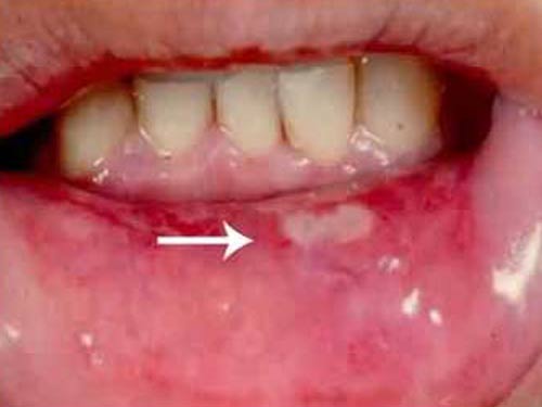 Nhiệt miệng và ... cách “xử trí”