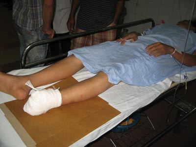 Máy khoan rơi, cắt lìa bàn chân 1 công nhân