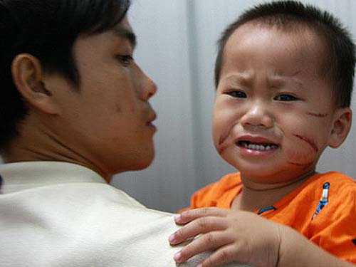 Bé gái 20 tháng tuổi bị ngược đãi