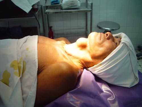 Phẫu thuật nội soi bướu cổ: Nhanh và “đẹp”!