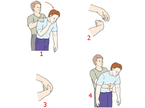 Dị vật đường thở: Rất nguy hiểm