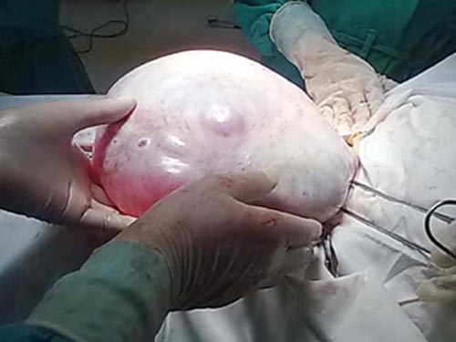 Bé 14 tuổi có u nang buồng trứng nặng 4,2 kg