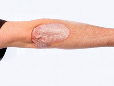 Viêm khớp vảy nến