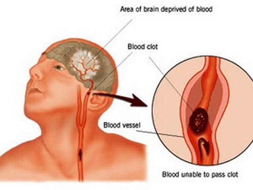 Hy vọng mới cho bệnh nhân đột quỵ