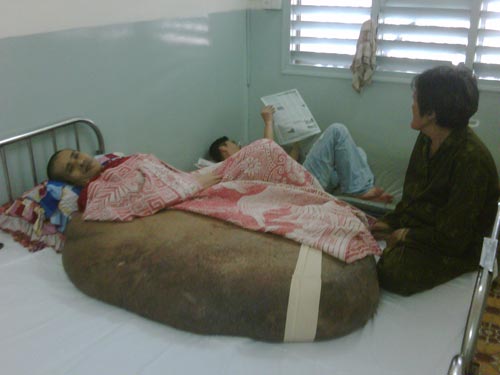 Không thể phẫu thuật cho bệnh nhân "chân voi"