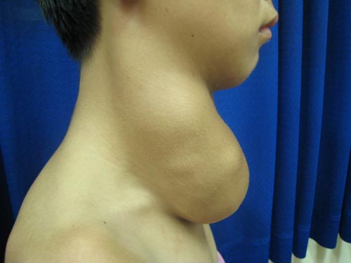 Giải thoát nỗi khổ 17 năm mang khối u khổng lồ