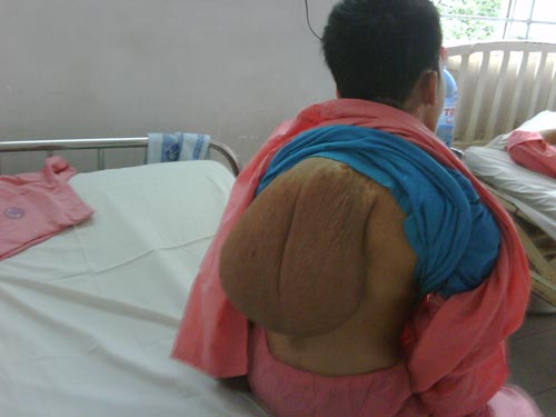 Chàng trai “lưng voi” 10 năm ngủ ngồi
