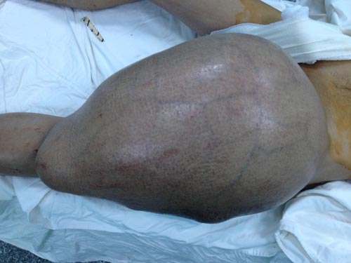 Mang u quái 12,5 kg trên đùi suốt nhiều năm