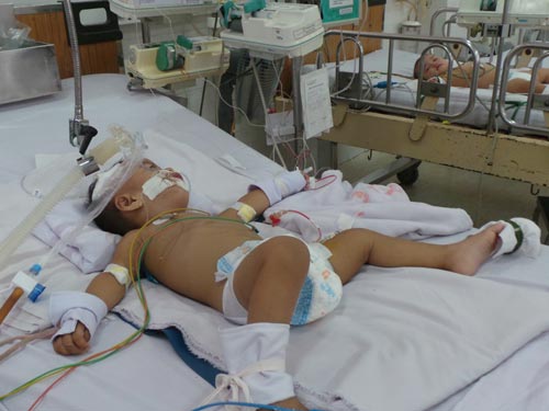 Hóc xương cá, bé gái nguy kịch