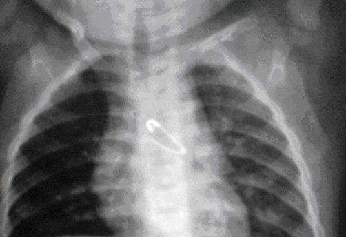Bé 10 tháng tuổi nuốt phải ghim băng mở bung