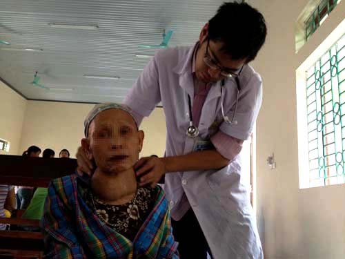 20 năm sống chung với bướu cổ khổng lồ