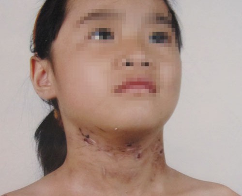 Nghi án bố đẻ và mẹ kế đánh gãy xương, bỏ bé 6 tuổi ngoài nghĩa địa