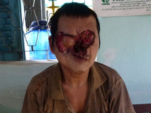Phá nốt ruồi, tiêu cả gương mặt