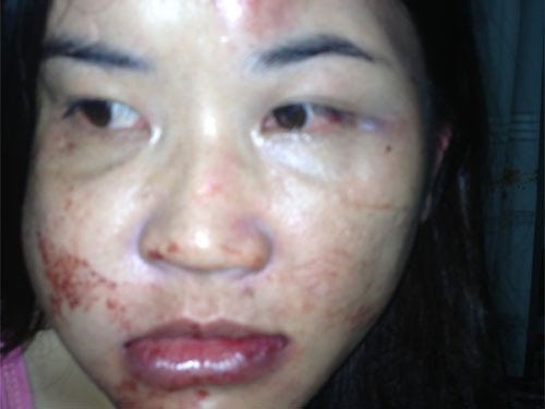 Cô giáo bị chồng hành hạ dã man
