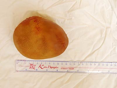 Lấy viên sỏi nặng 0,8 kg ra khỏi người bệnh nhân