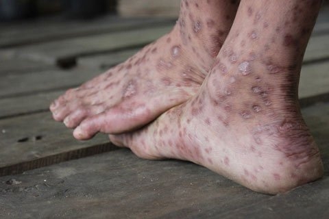 Trị “bệnh lạ” ở Quảng Ngãi là thành tựu của ngành y tế!