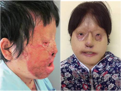 Trả lại khuôn mặt sau 9 giờ phẫu thuật