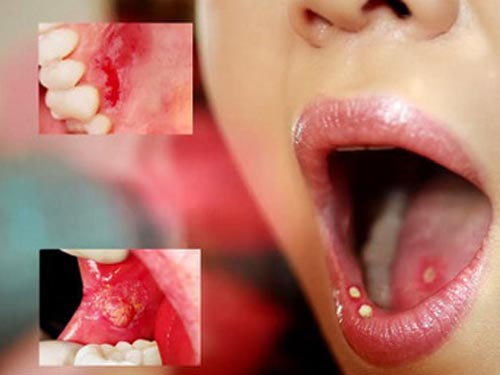 Thuốc dùng khi bị nhiệt miệng