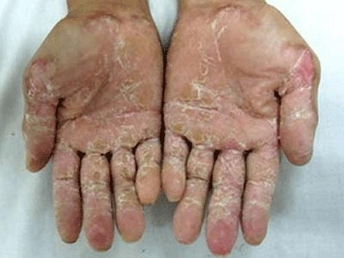 Một ca nghi mắc bệnh “lạ” tử vong