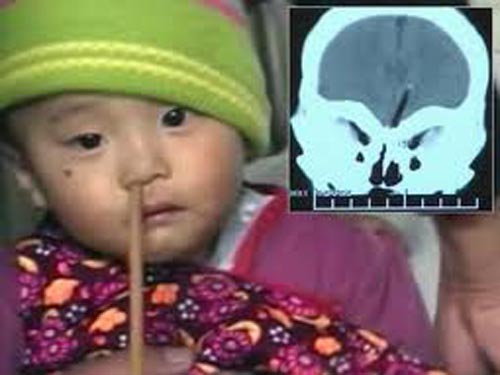 Cứu bé trai bị đũa xuyên đáy sọ