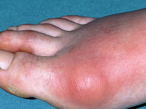 Triển vọng trị bệnh gout