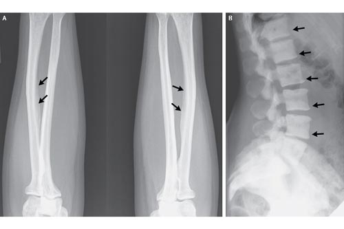 Xương biến dạng do uống quá nhiều nước trà