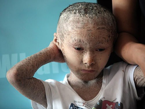 Thương tâm cậu bé "người cá"