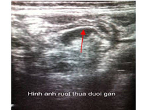 Thủng ruột thừa do tự điều trị