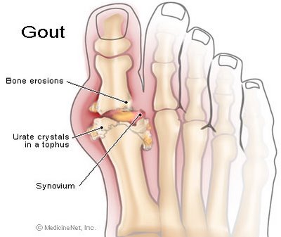 Ăn uống cho người bị bệnh gout