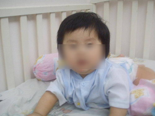 Bé gái bị chẩn đoán "phù nề bao quy đầu"