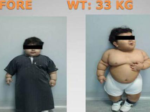 Bé trai 2 tuổi phẫu thuật cắt dạ dày để giảm cân