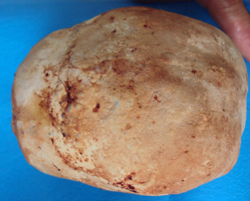 Lấy viên sỏi 1 kg từ bàng quang người đàn ông