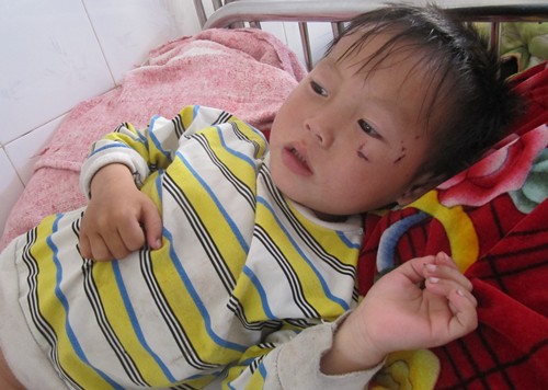 Cháu bé 3 tuổi bị chó cắn rách dương vật