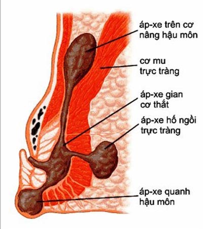 Ruột rò, nỗi lo bệnh tật