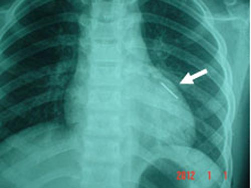 Cứu trẻ bị súng bắn đinh xuyên ngực