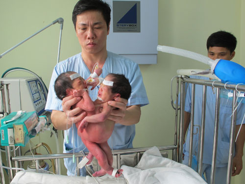 Đáng thương cặp song sinh dính bụng, hậu môn