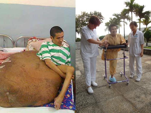 Những bước đi đầu tiên của bệnh nhân “chân voi”