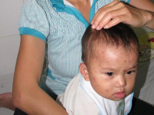 Bé gái chưa tròn năm bị ong đốt 100 mũi