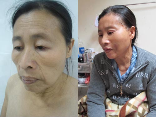 Bệnh nhân “hóa lão” đi phẫu thuật thẩm mỹ