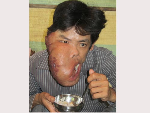 Bị bướu “ăn” nửa mặt
