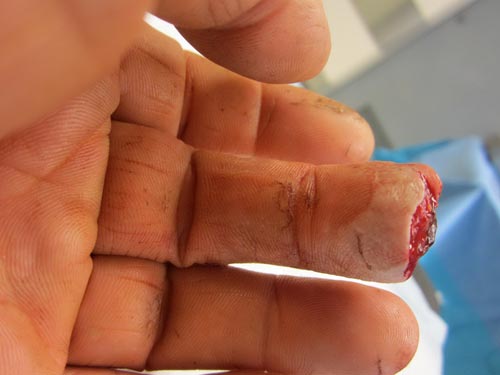 Nối ngón tay đứt lìa cho kỹ sư dầu khí nước ngoài