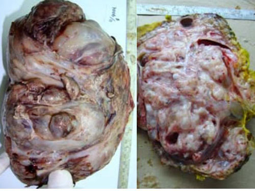 Bé 4 tháng tuổi mang khối u quái khổng lồ